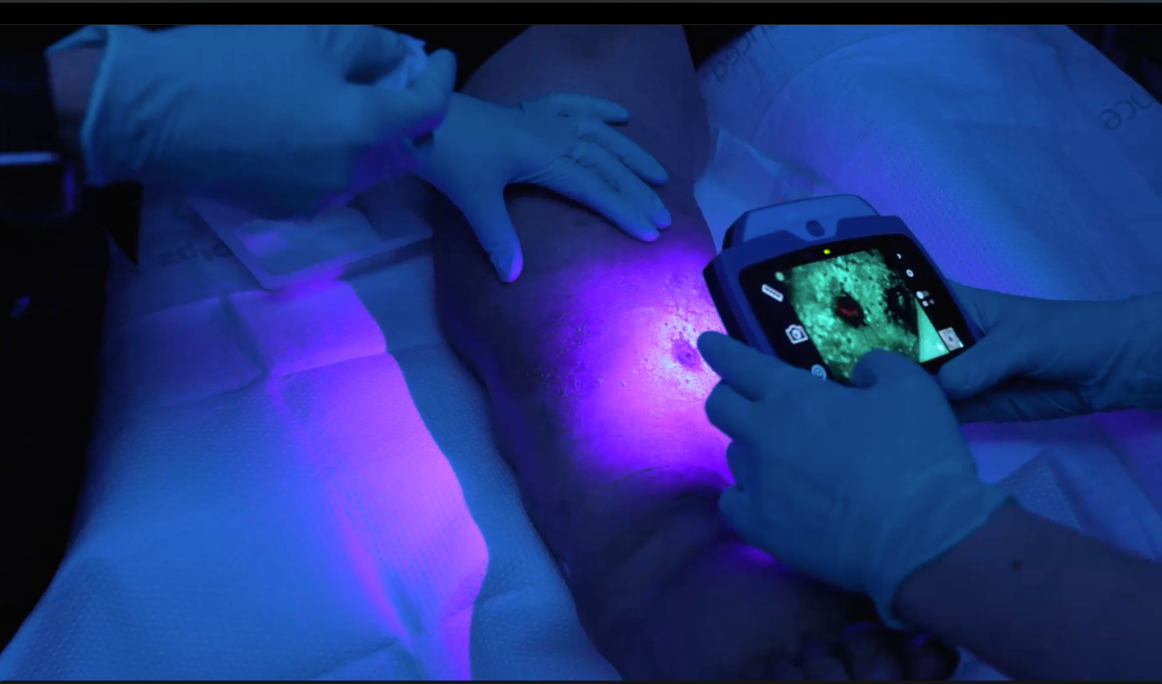 MolecuLight mobile wound care instrument being used on a patient's leg
